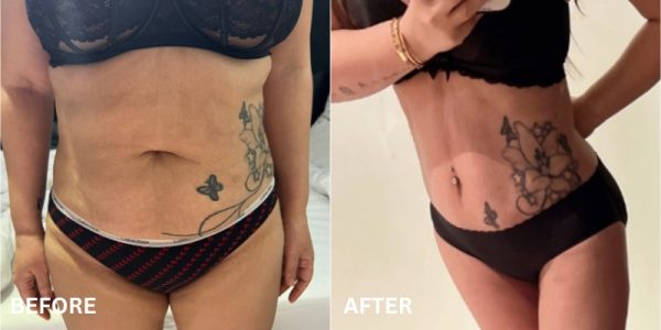 tummy tuck korea before after