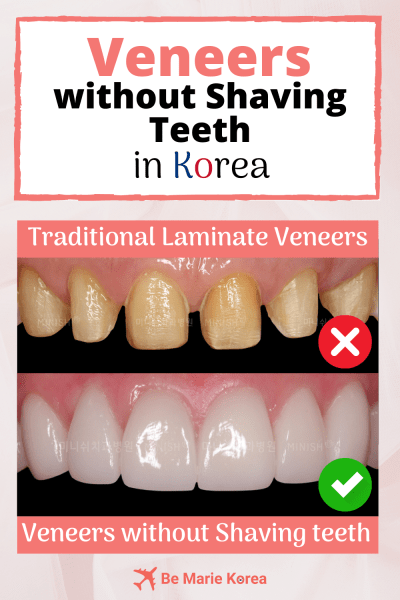 veneers korea