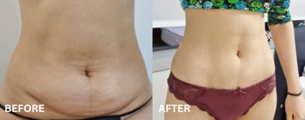 tummy tuck korea before after