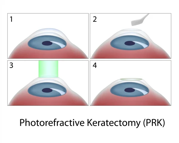 cost of lasik eye surgery korea