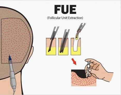 south korea hair transplant cost