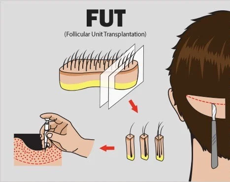 hair transplant in korea price