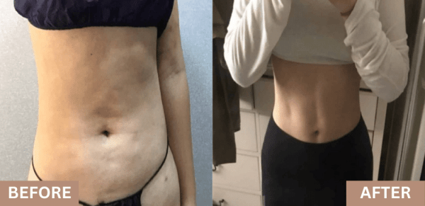 lydian tummy tuck before after korea
