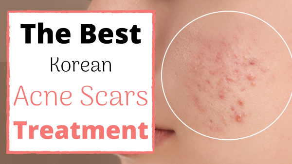 korean acne scars treatment