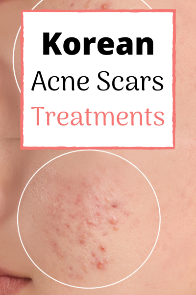 best korean acne scar treatment