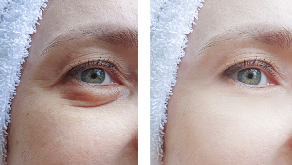 korean treatment for dark circles
