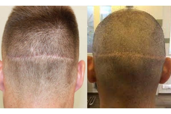hair transplant cost south korea