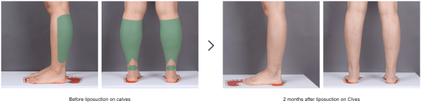 calf reduction surgery in korea before after