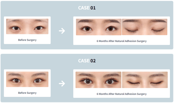 eyelid surgery asian before and after