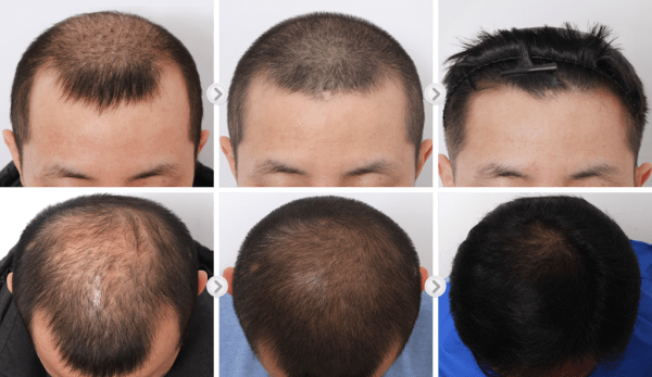 hair loss treatment korea before after