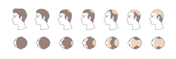 hair loss treatment korea maxwell