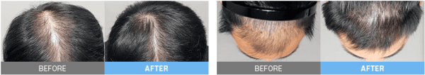 hair loss treatment stem cell lydian