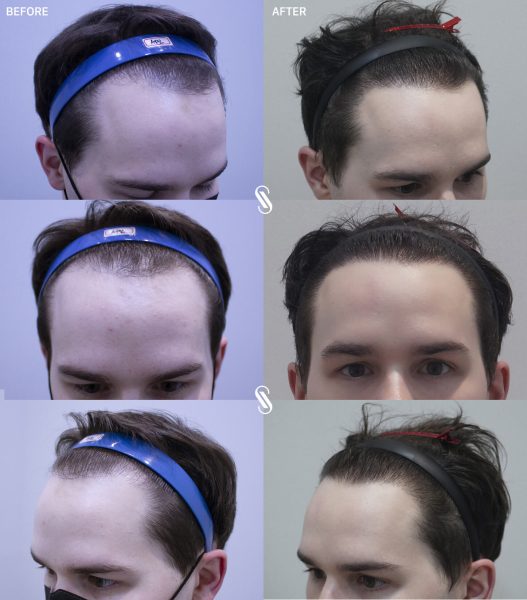 seojin cost of hair transplant korea