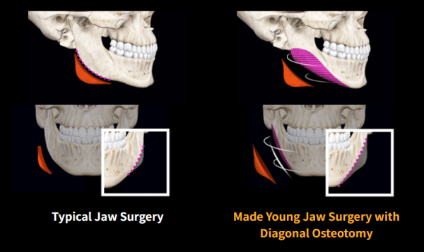 jaw surgery korea