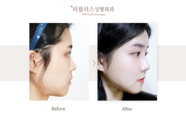 jaw surgery korea before after