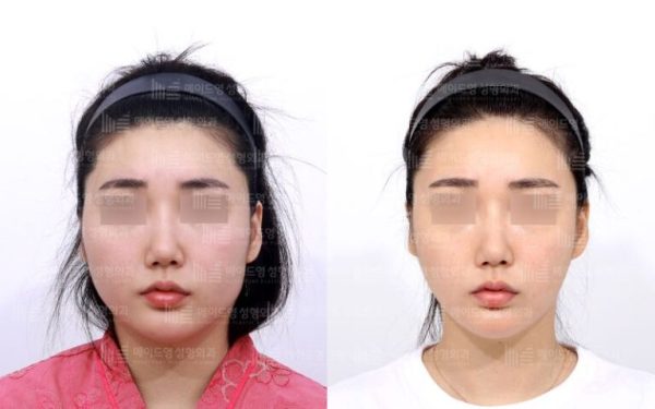 jaw surgery korea cost