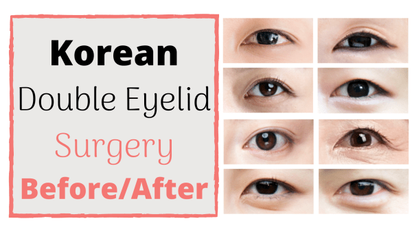 korean double eyelid surgery before and after