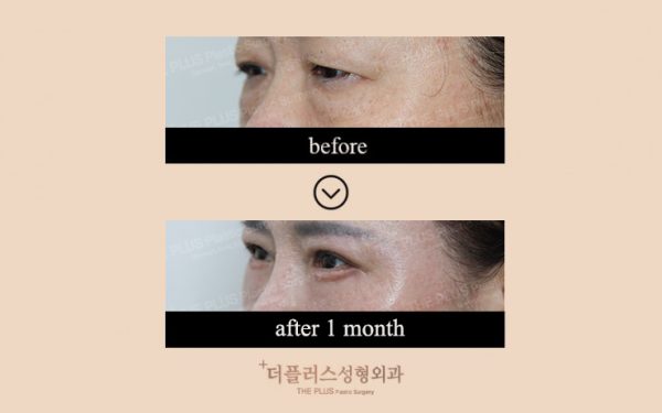 korean double eyelid surgery before and after
