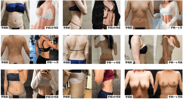 liposuction in korea before after