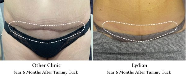 lydian tummy tuck scar korea