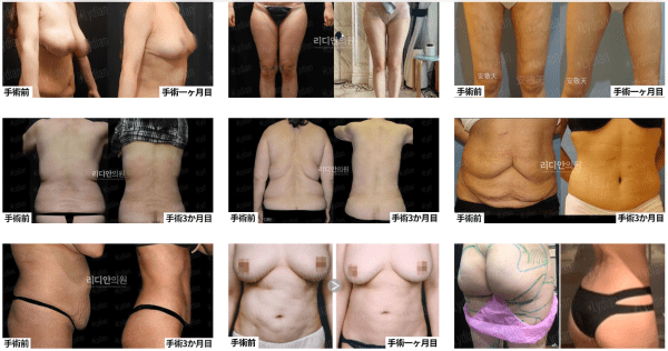 mommy makeover in korea before after