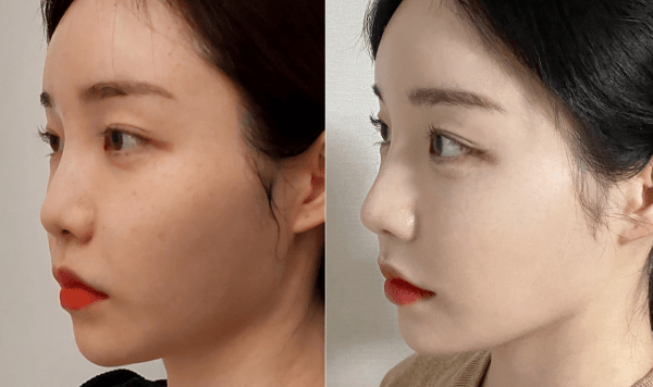 nose thread lift korea before after