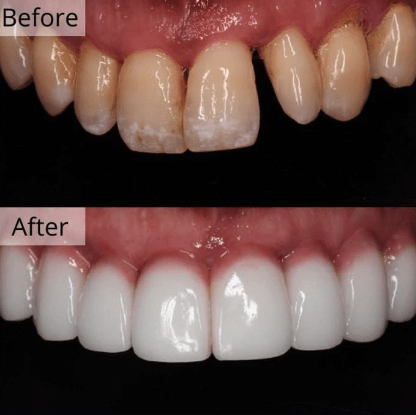 pink veneers minish korea