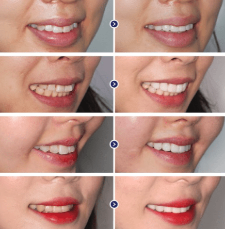 veneers before after korea