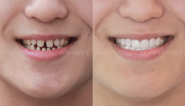 veneers seoul before after