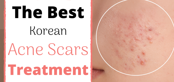 korean acne scars treatment