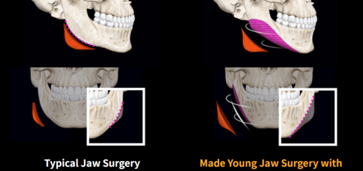 jaw surgery korea