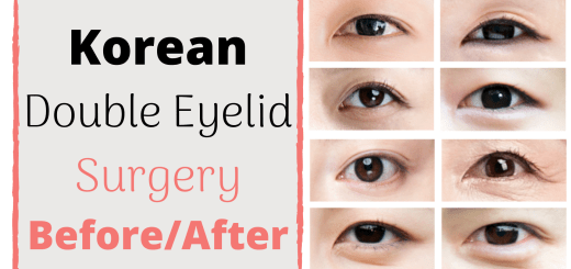 korean double eyelid surgery before and after