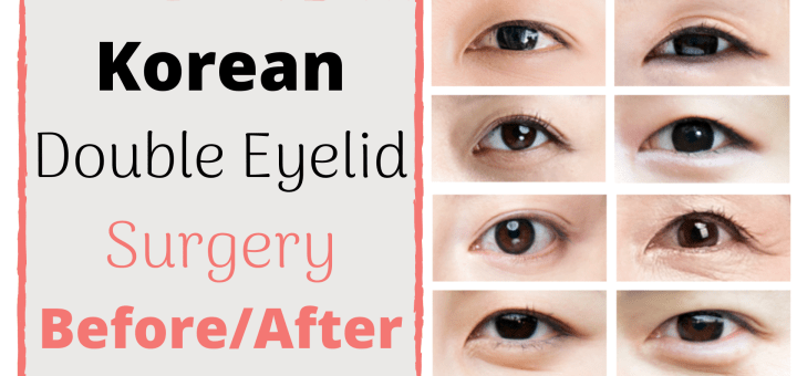 korean double eyelid surgery before and after